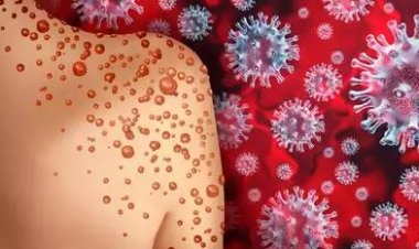 Mpox is not the new COVID, according to a WHO official. Here's what you need to know about different strains of monkey pox.