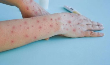 Odisha on high alert after India's first suspected case reported for Mokneypox